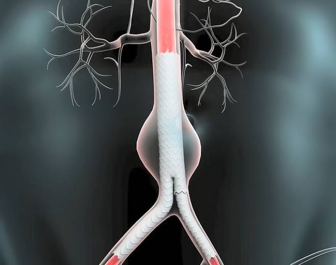 Endovascular stent graft inside abdominal aorta