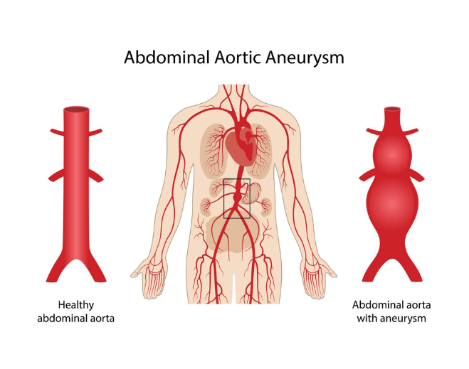 Diagram showing abdominal aortic aneurysm