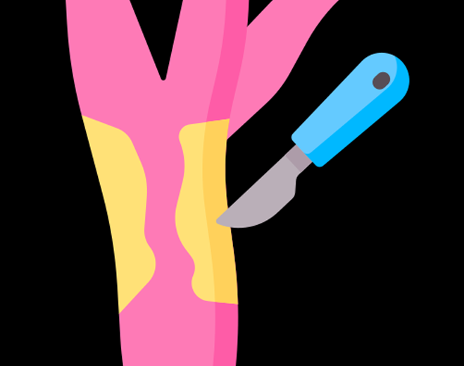 Illustration of carotid endarterectomy procedure
