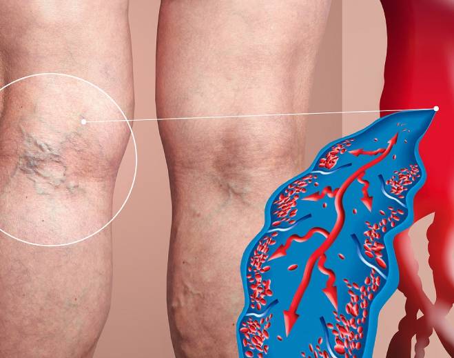 Close‑up of varicose veins with diagram
