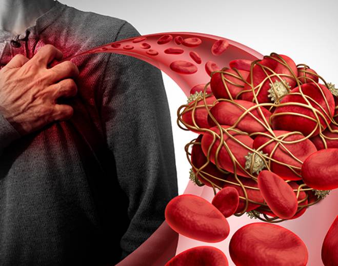 Chest discomfort with blood clot illustration