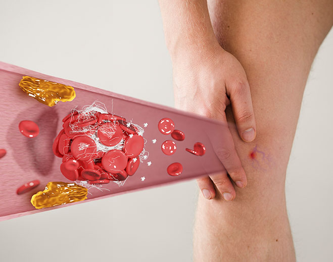 Blood clot illustration over leg pain