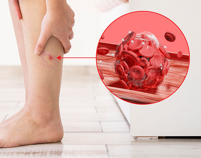 Calf pain with blood clot inset