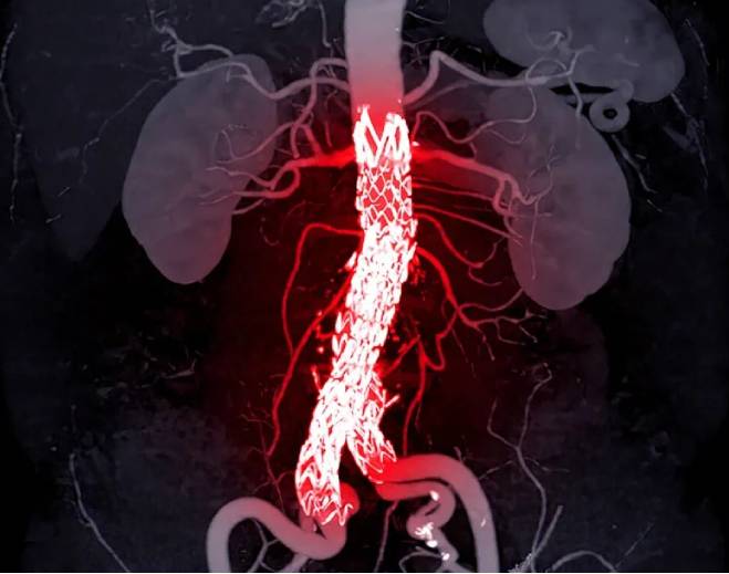 Abdominal aortic aneurysm with stent graft