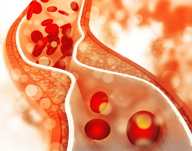 Illustration of blood flow in narrowed artery
