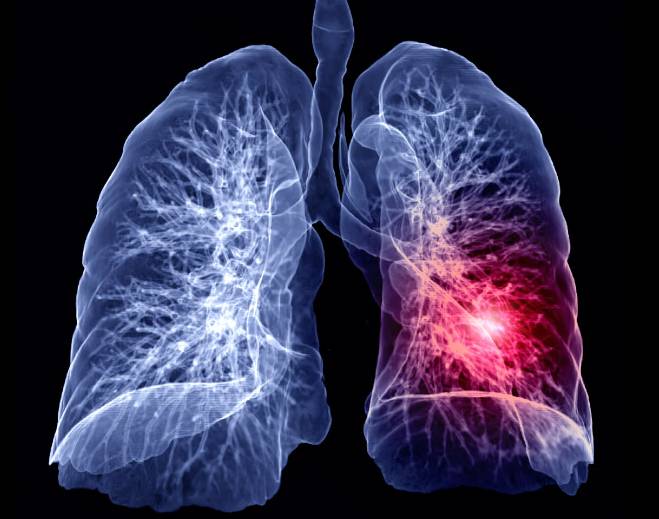 Lung scan highlighting abnormal affected region