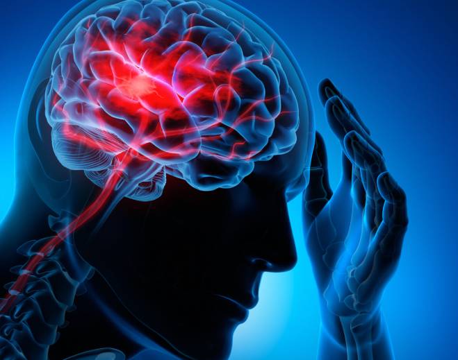 Brain illustration highlighting stroke‑affected area