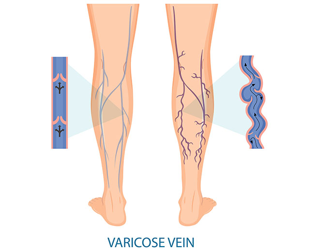Diagram of varicose veins and edema