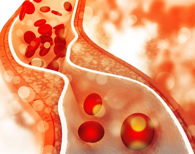 Illustration of blood flow through narrowed artery