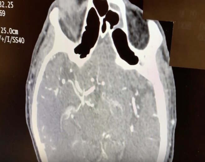Brain CT scan medical imaging