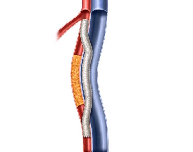 Illustration of stent placed in artery
