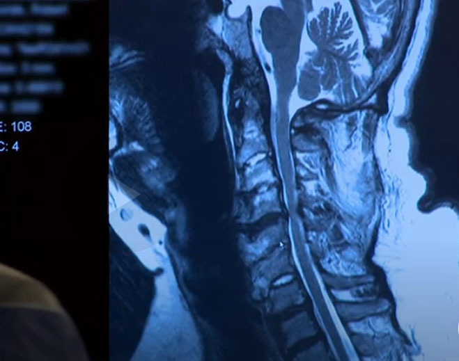 Cervical spine MRI scan on screen