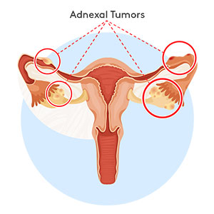 adnexal-tumors-300x300 Diagram showing adnexal tumors locations