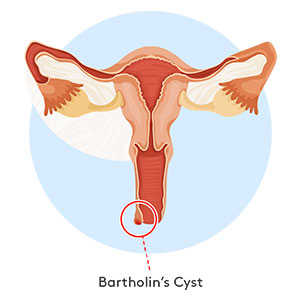 bartholins-cyst-300x300 Bartholin’s gland cyst diagram