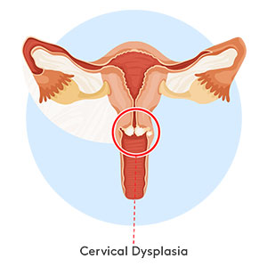 cervical-dysplasia-300x300 Cervical dysplasia illustration of cervix