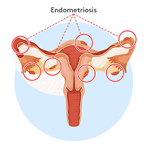 endometriosis-300x300 Illustration highlighting endometriosis in reproductive system