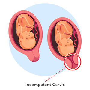 incompetent-cervix-300x300 Incompetent Cervix Diagram