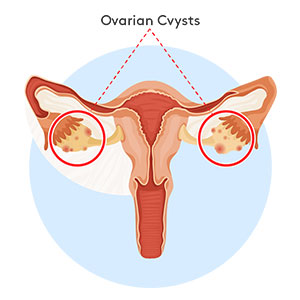 ovarian-cysts-300x300 Ovarian Cysts Diagram