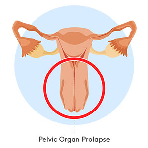 pelvic-organ-prolapse-300x300 Diagram showing pelvic organ prolapse condition