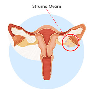 struma-ovarii-300x300 Illustration highlighting Struma Ovarii