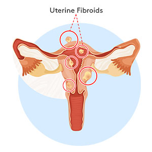 uterine-fibroids-300x300 Illustration highlighting uterine fibroids in uterus